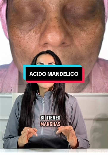 Piel sensible, con manchas o textura irregular? Este activo puede cambiar tu piel (de verdad) ✨ El ácido mandélico es uno de los favoritos cuando buscas resultados sin irritar. ¿Por qué? Porque trabaja de forma más suave, pero efectiva: ✔️ Ayuda a aclarar manchas ✔️ Mejora la textura y apariencia de los poros ✔️ Es ideal para pieles sensibles o reactivas ✔️ Aporta renovación sin agredir tu piel En Cosmopolita lo usamos en protocolos diseñados según tu tipo de piel, porque no todo es “usar un pro