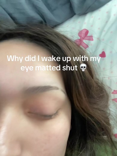 Why Is My Eye Matted Shut? Causes and Remedies