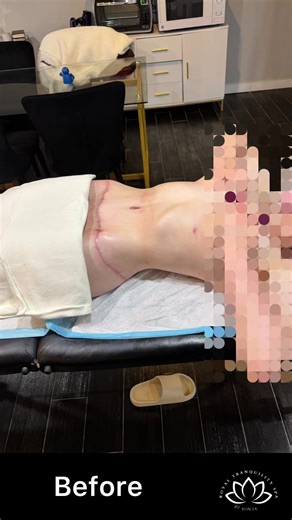 Post-surgical massage doesn’t just support the healing process—it enhances the results too. And this beauty right here is living proof. She committed to over 20 sessions because she understood the assignment: faster healing, minimized seroma and fibrosis, and results that speak for themselves. When you trust the process, the results will absolutely show—no filter needed. #massage #lymphicdrainage #recovery #results