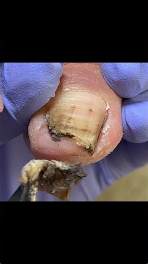 Long, Dirty Toenails, Trimmed Silky Smooth #nails #satisfying