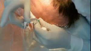Surgeon in latex gloves making injection of local anesthesia into head of bald patient during hair transplantation procedure. Problem of baldness, treatment of alopecia by hair transplantation.