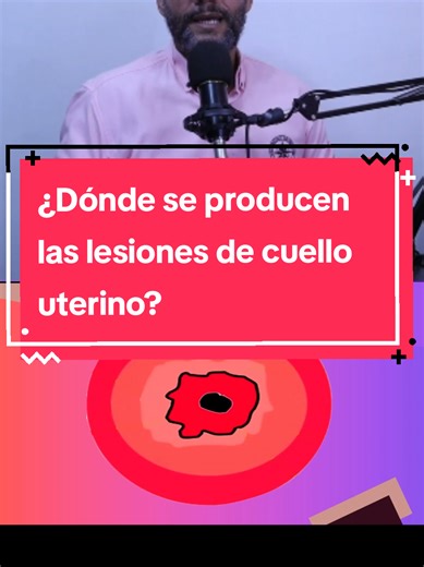 ¿Dónde se producen las lesiones de cuello uterino? #VPH #prevención #ginecologia #cuellouterino #lesionesdecuellouterino