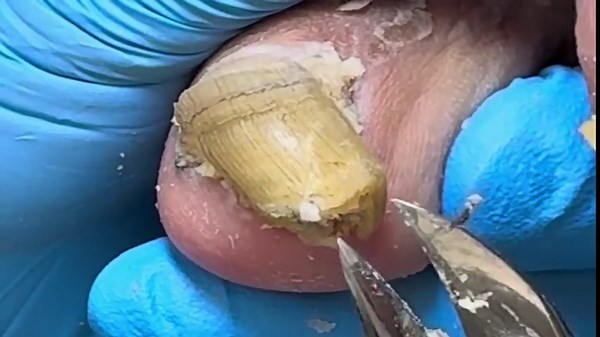 Effective Pedicure Techniques for Treating Onychomycosis