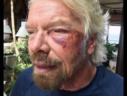Sir Richard Branson injured in crash