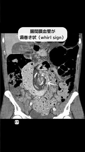 S状結腸捻転 #radiology#単純写真#ショート#shorts#レントゲン #anatomy #画像診断