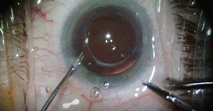 Light Adjustable Lens Explantation - Eyetube
