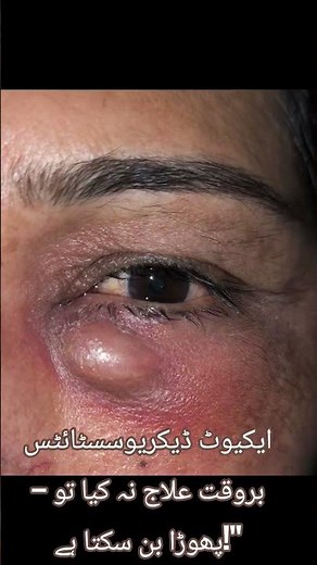 Blocked tear duct + infection = acute dacryocystitis. Early treatment prevents abscess and fistula.