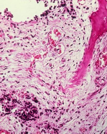 What is Ewing sarcoma?