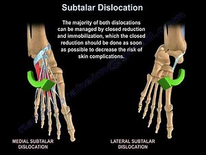 Subtalar Dislocation Types and Treatment • Video • MEDtube.net