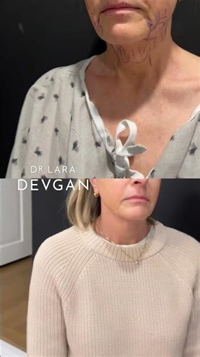 Midface lift, lower facelift, neck lift #plasticsurgery #plasticsurgeon