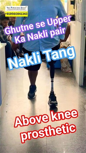 Above knee prosthesis | Best Artificial Leg In India #prostheticlimb #bestclinic #ossur #ottobock