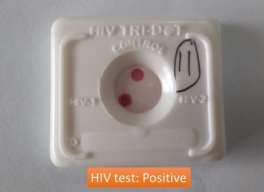 HIV Test Positive: Introduction, Principle, Procedure, Result Interpretation
