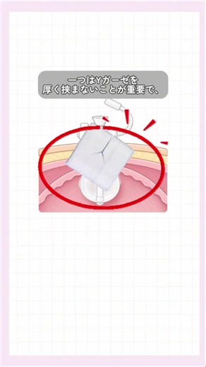 【多くが知らない！胃瘻管理は？】#医療#消化器#外科#看護#看護師#看護師2年目#新人看護師 #看護師勉強垢 #胃瘻