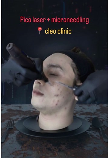 Microneedling and Pico Laser Treatment Explained