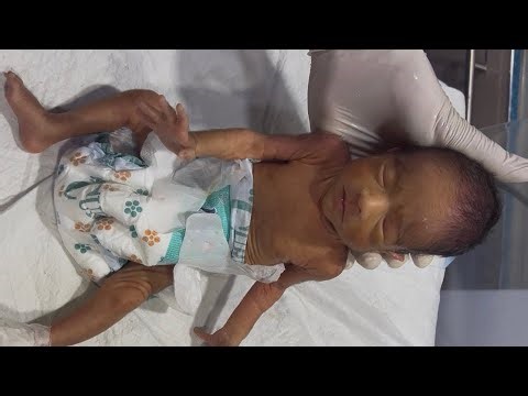 How to Care and Feed a Low Birth Weight (LBW) Baby?#cute #baby #neonatologist #premature #newborn