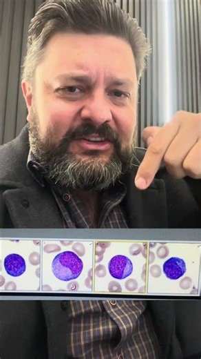 Blast and Reactive Lymphocyte - how to differentiate them