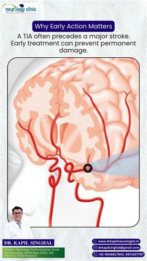 A mini-stroke isn’t “minor” — it’s your body’s final warning. Sudden weakness, speech trouble, or vision loss should never be ignored. Act fast. Early care can prevent a life-altering stroke. #MiniStroke #TIAAwareness #StrokeWarning #ActFast #BrainHealth #NeurologyCare #StrokePrevention | Neurology Clinic