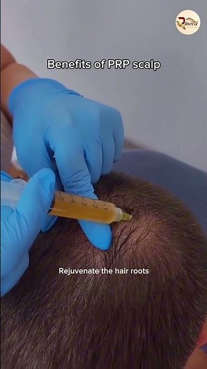 PRP Scalp Treatment: Benefits for Hair Growth & Hair Loss | PRP Explained