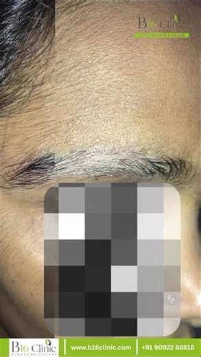 ✨ ILS Treatment – Real Results at B16 Clinic!