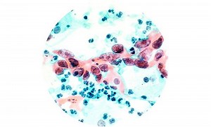 Papillomavirus humain (HPV)
