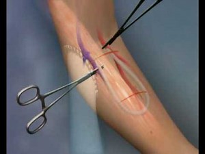 AVflo™ Vascular Access Graft - Demo