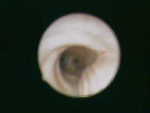 Arndt endobronchial blockers.