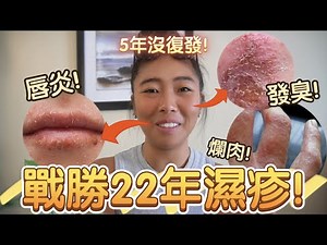 【3招濕疹治根!】告別22年濕疹、汗皰疹！睇遍中醫,西醫,食療,自然療法...都沒辦法！竟然靠XX痊癒了!濕疹止癢斷尾秘笈！日常皮膚護理,飲食, 生活習慣