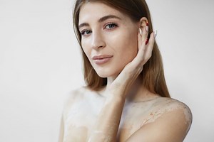 Les causes du vitiligo - Association Française du Vitiligo
