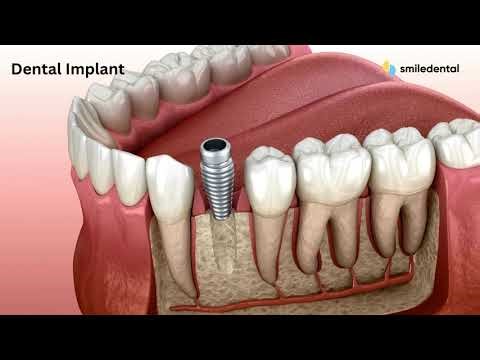 DENTAL IMPLANT PROCEDURE