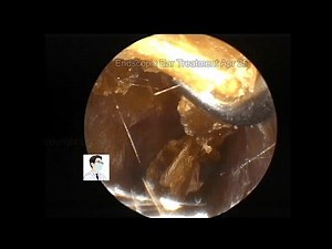 Periodic review for cholesteatoma of the external auditory canal.20220425 youtube
