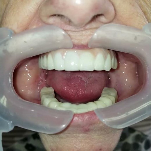 See full arch dental implant prosthetics. FP1 and FP2 PMMA and Zirconium Dr. Josh Brower DDS.