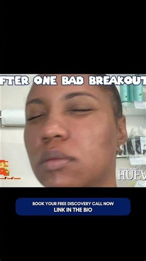 Having Cystic Acne Is Like...