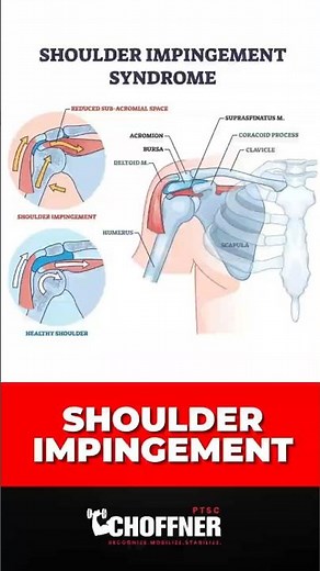 Must-Do Exercises to End Shoulder Impingement Pain
