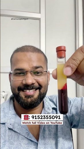 First Platelet Rich Plasma Therapy (PRP) After Hair Transplant in Delhi