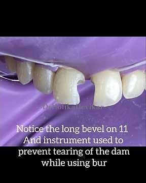 Anterior Tooth Filling Step-by-Step | Composite Restoration with Real Patient Case