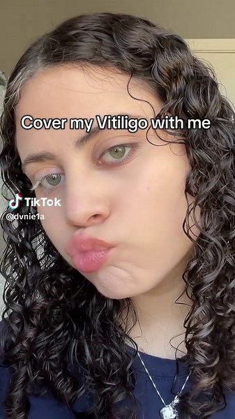 Covering Vitiligo with Makeup Tips and Tricks