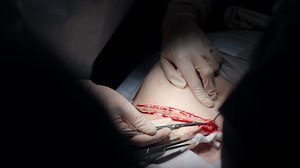 Close-up of a cesarean section in a modern hospital. The image captures the surgical procedure with precise details, highlighting the advanced medical environment and careful attention to the delivery