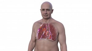 Primary Lung Tuberculosis Man Ghon Complex Animation Showing Pulmonary Lesion