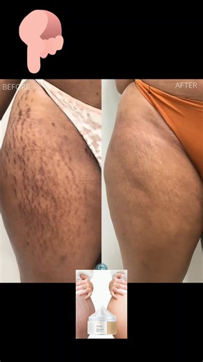 stretch mark before and after #skincaretips #stretchmarks #beauty #problemsolved