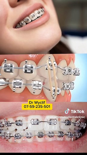 Understanding How Braces Work: A Comprehensive Guide