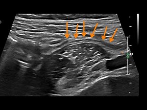 [Ultrasound Case] Normal Colon and Appendix – Live Demonstration