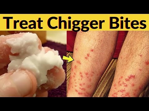 Baking Soda Trick to Treat Chigger Bites Naturally At Home