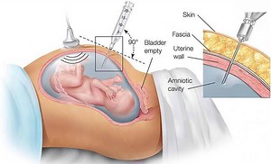 Amniocentesis - Test Accuracy, Risks, Complications