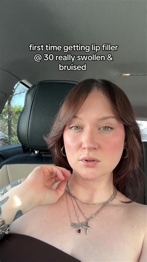 My First Time Getting Lip Filler at 30