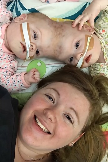 Conjoined twins Abby and Erin Delaney, who had only a 2% chance of survival at birth, recently reached an impressive milestone: both have graduated from kindergarten. Born prematurely at 30 weeks on July 24, 2016, they faced a very complex medical situation from the start. Their mother discovered at 11 weeks of pregnancy that her daughters were craniopagus, joined at the skull. This rare condition made the twins extremely vulnerable to serious complications. The girls shared a skull, skin, and a