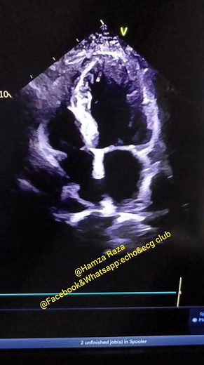 #short_case Identify the regional wall motion abnormality? #echo_and_ecg_club | echo and ecg club