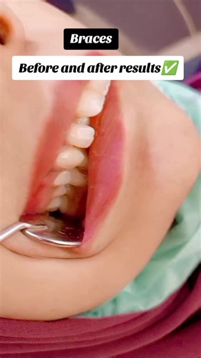 Transform Your Smile: Braces Before and After Results