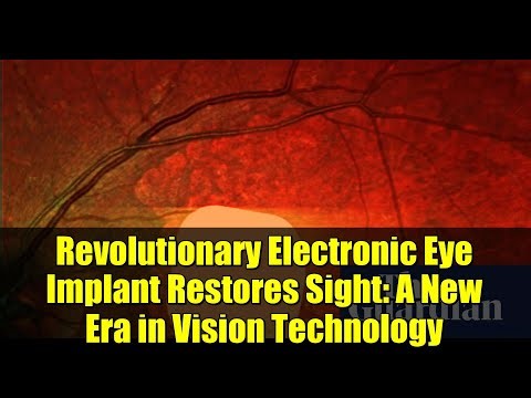 Revolutionary Electronic Eye Implant Restores Sight: A New Era in Vision Technology