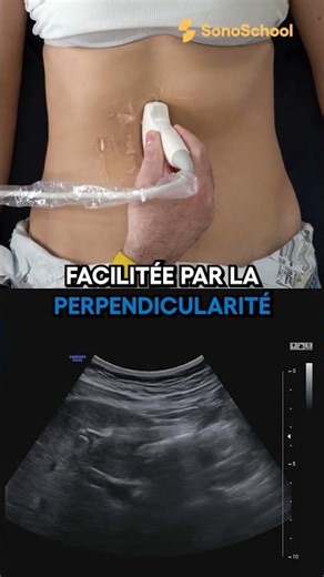 Pancréas : coupe transversale et qualité d’image - iSonic | SonoSchool