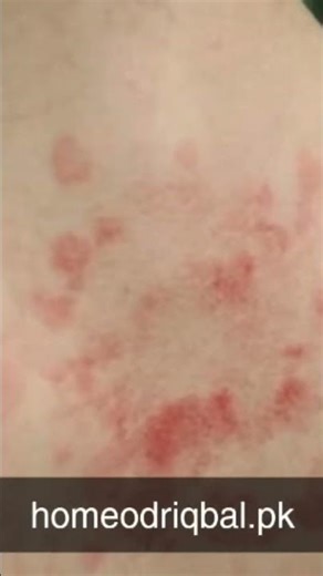 Upper Back Allergy – Common Causes (Awareness Post)